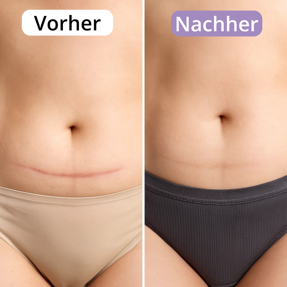 AveraSkin - Silikonpflaster gegen Narben und Falten