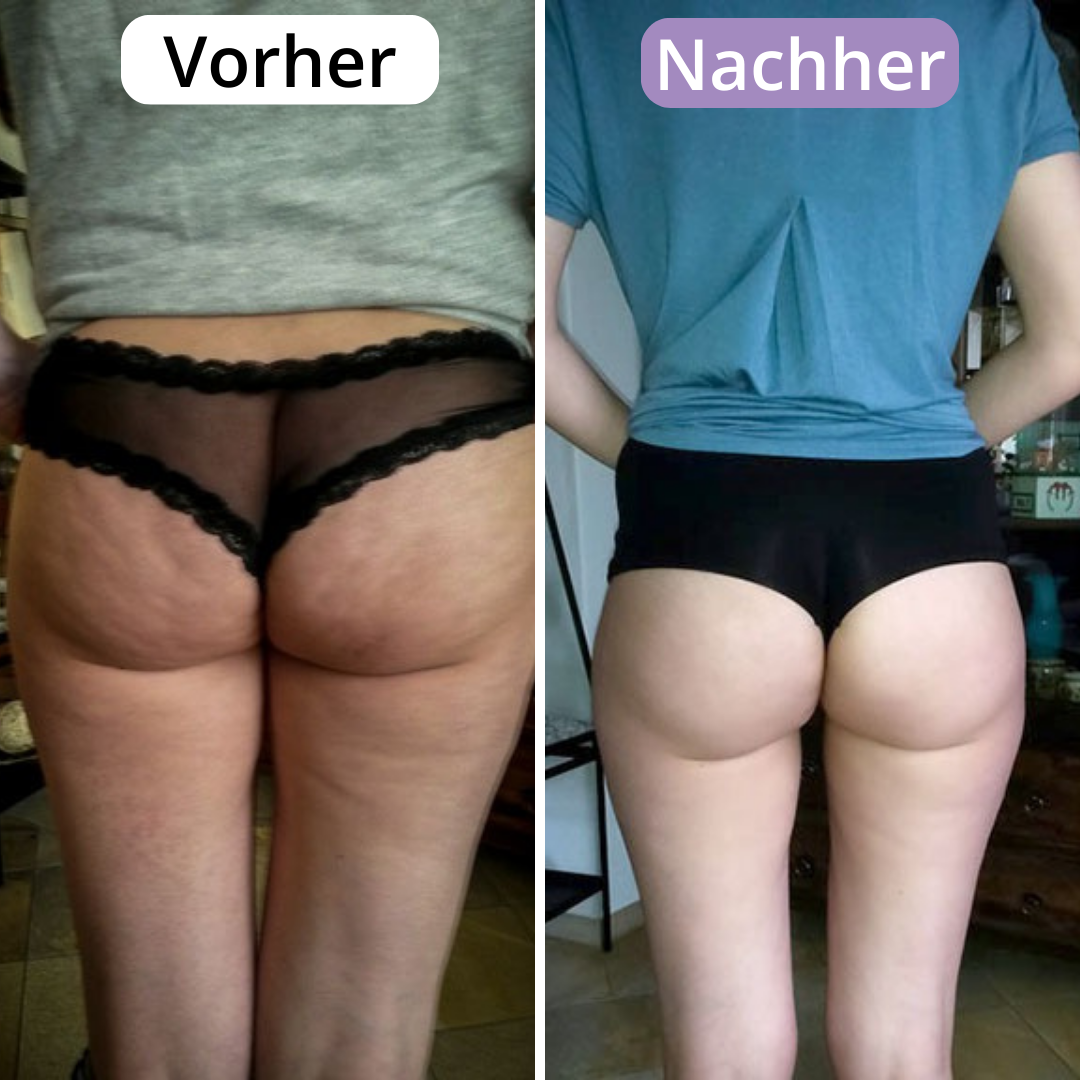 AveraSkin - Das Massagegerät gegen Cellulite