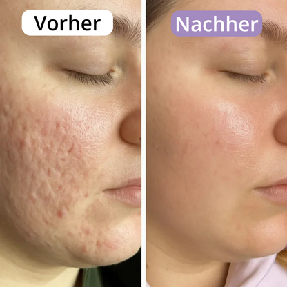 AveraSkin - Silikonpflaster gegen Narben und Falten